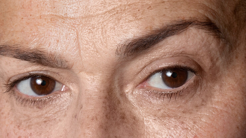 10 Essential Considerations Before Undergoing Brow Lift in Dubai
